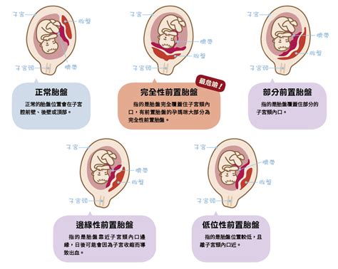 隱藏性胎盤剝離|了解胎盤早期剝離原因，預防早期胎盤剝離風險，13大。